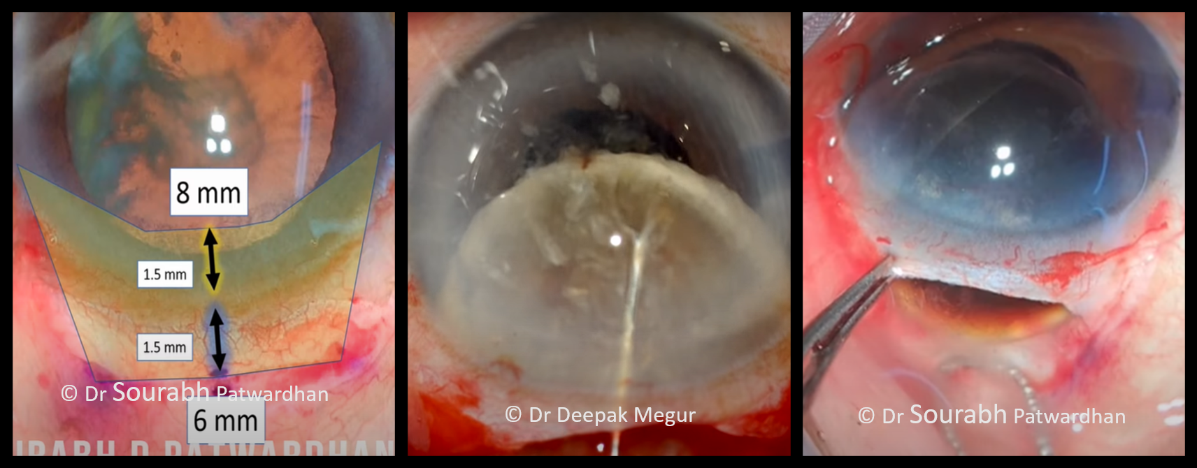 Small Incision Cataract Surgery (SICS)