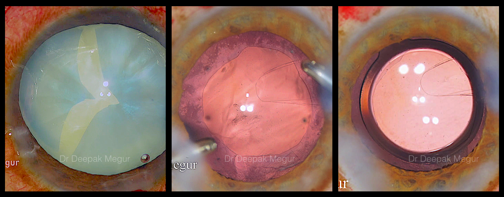 Complications and management - Phaco